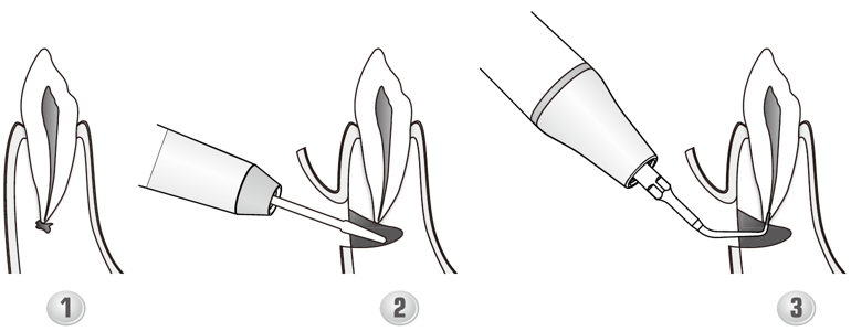 Сфера применения наконечника для скалера